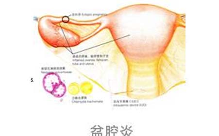 盆腔积液小腹痛怎么办 盆腔积液左侧小腹痛怎么办